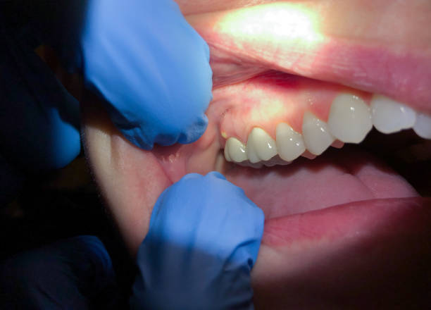 Best Knocked-Out Tooth Emergency  in Crestview, FL